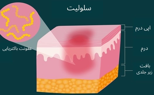 سلولیت