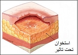 ارزیابی زخم بستر 4