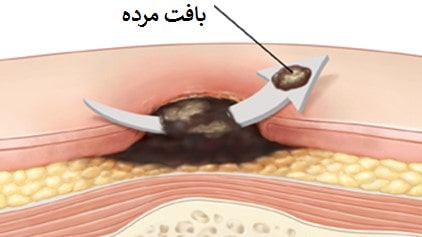 دبریدمان زخم بستر
