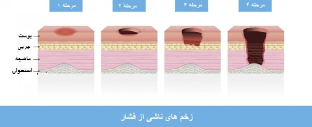 درجات زخم بستر