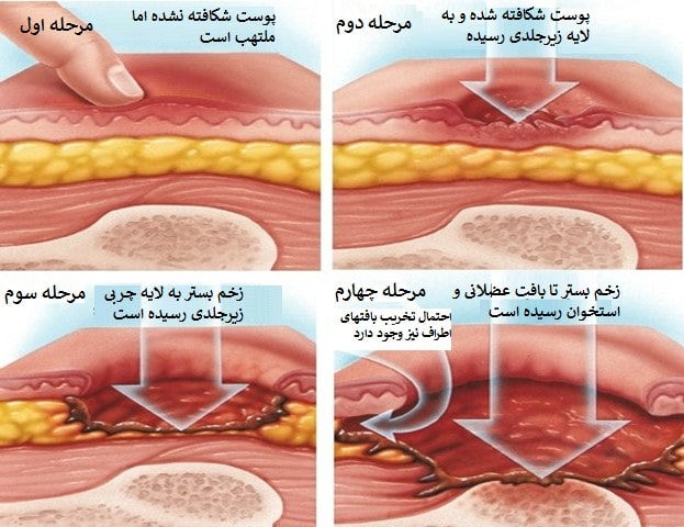 درجات زخم بستر