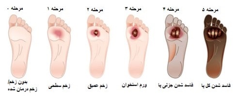 درجات زخم پا دیابتی