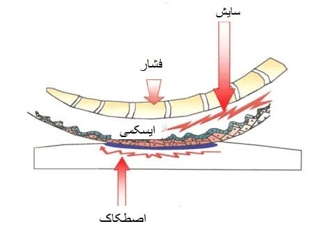 دلایل زخم بستر