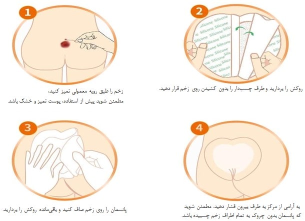 روش استفاده از چسب زخم بستر