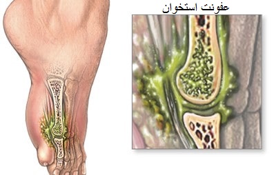 عفونت استخوان و مفصل