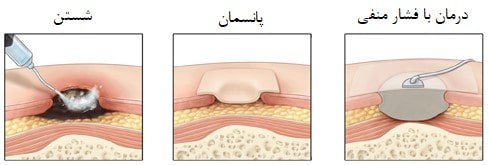 مراقبت و مدیریت زخم بستر