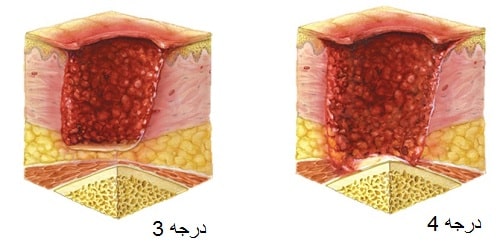 موارد کاربرد جراحی زخم بستر 